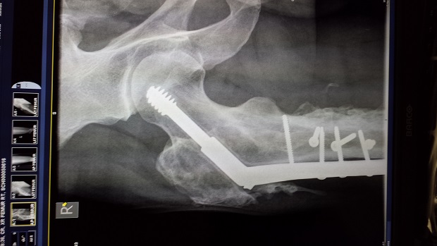 Recent x-ray showing the bolts in place